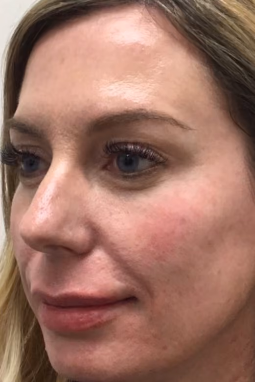 Botox before and after, Olivia Salmen, case 17341 - Cool Springs Plastic Surgery
