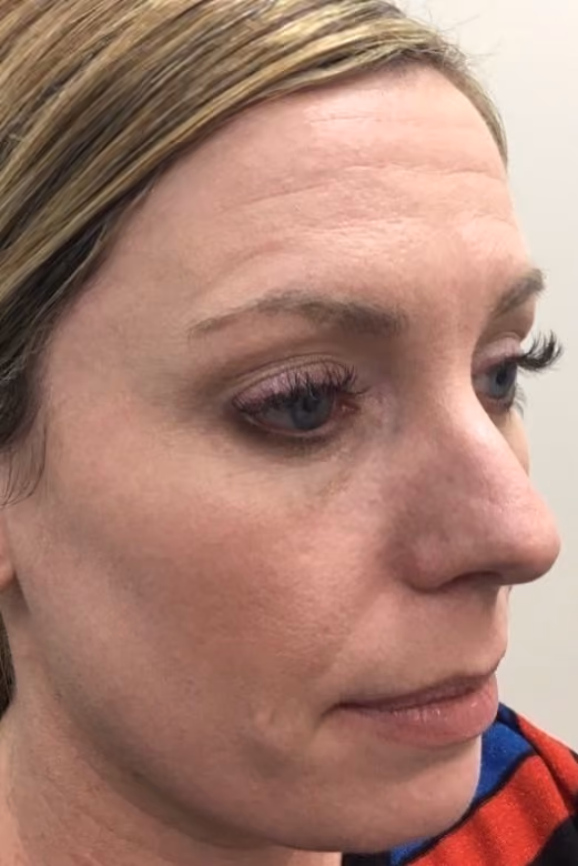 Botox before and after, Olivia Salmen, case 17341 - Cool Springs Plastic Surgery