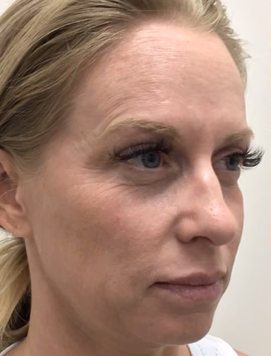 Botox before and after, Olivia Salmen, case 17405 - Cool Springs Plastic Surgery
