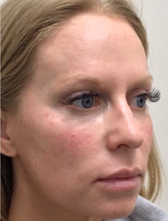 Botox before and after, Olivia Salmen, case 17405 - Cool Springs Plastic Surgery