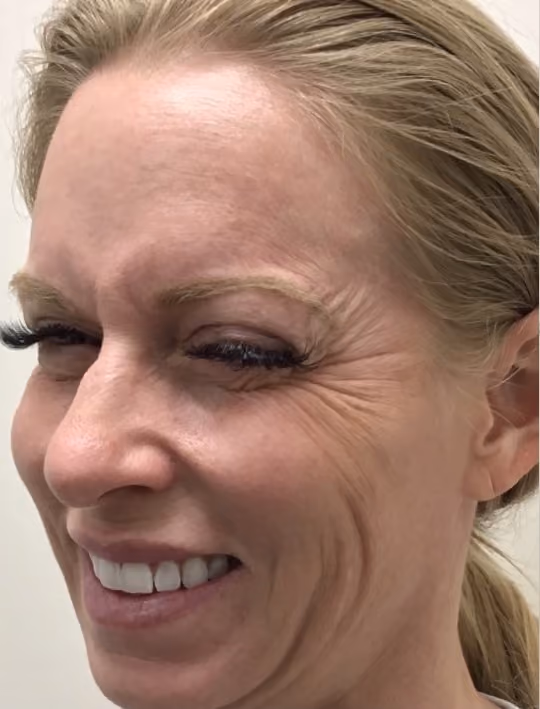 Botox before and after, Olivia Salmen, case 17405 - Cool Springs Plastic Surgery
