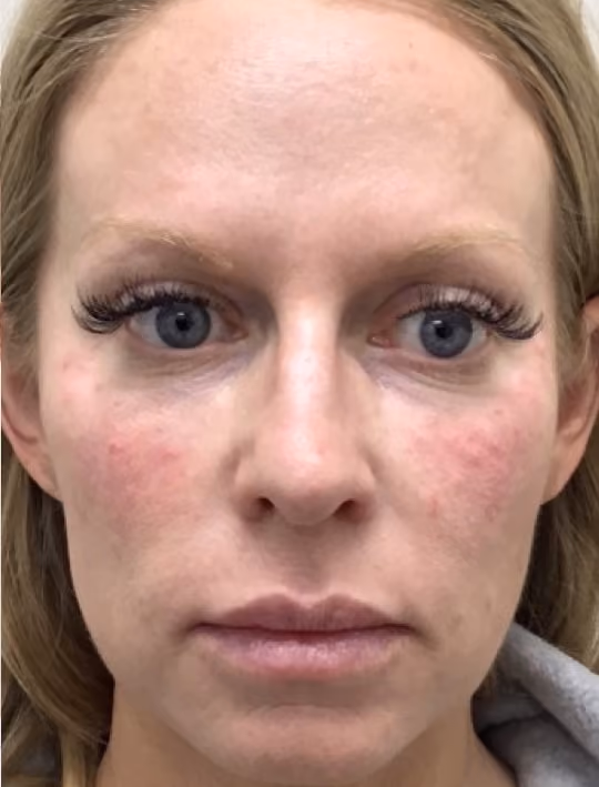 Botox before and after, Olivia Salmen, case 17405 - Cool Springs Plastic Surgery