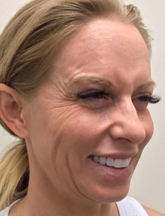 Botox before and after, Olivia Salmen, case 17405 - Cool Springs Plastic Surgery