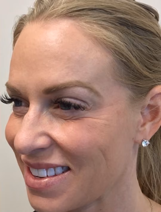 Botox before and after, Olivia Salmen, case 17405 - Cool Springs Plastic Surgery