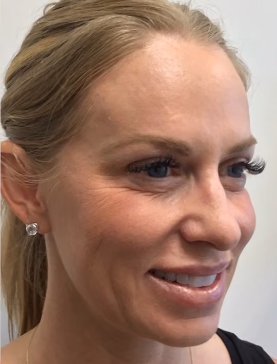 Botox before and after, Olivia Salmen, case 17405 - Cool Springs Plastic Surgery