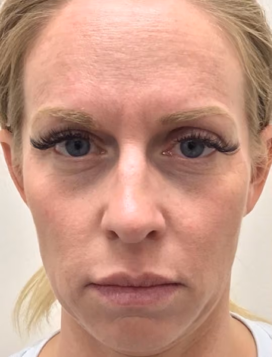 Botox before and after, Olivia Salmen, case 17405 - Cool Springs Plastic Surgery