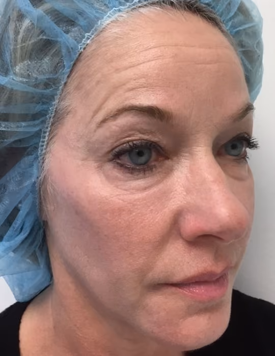 Botox before and after, Chrissy Handly, case 18582 - Cool Springs Plastic Surgery