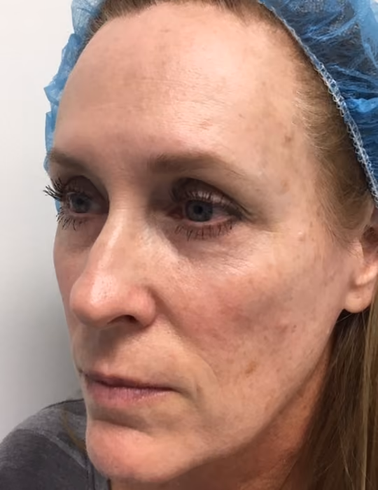 Botox before and after, Chrissy Handly, case 18588 - Cool Springs Plastic Surgery