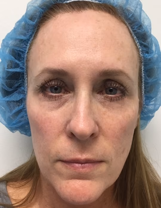 Botox before and after, Chrissy Handly, case 18588 - Cool Springs Plastic Surgery