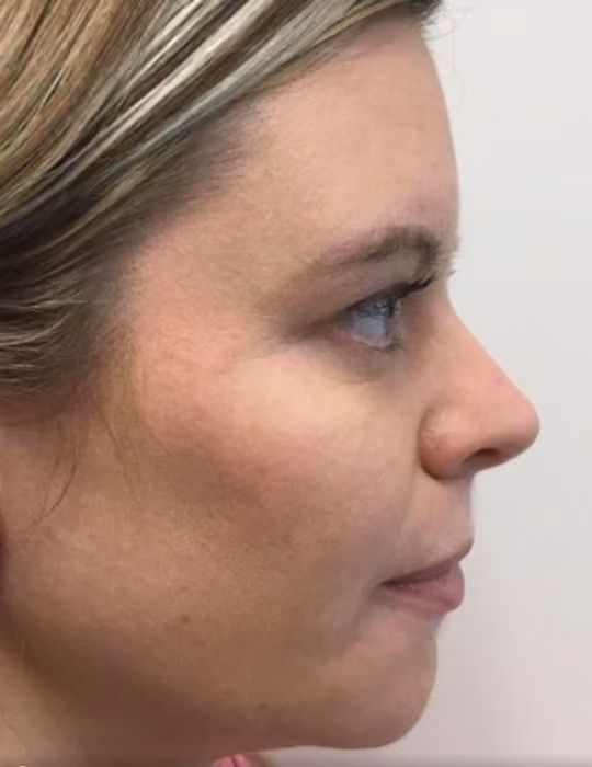 Botox before and after, Chrissy Handly, case 18609 - Cool Springs Plastic Surgery