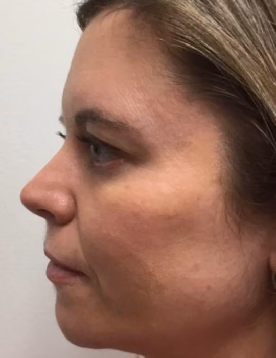 Botox before and after, Chrissy Handly, case 18609 - Cool Springs Plastic Surgery