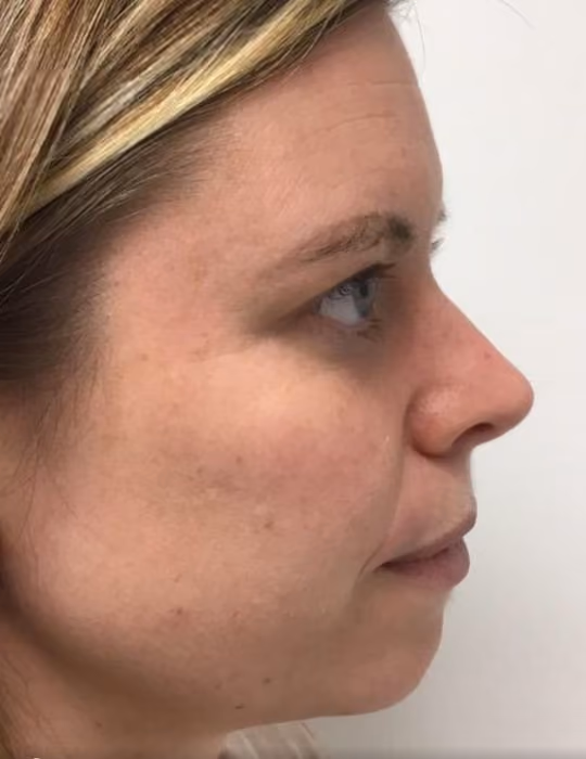 Botox before and after, Chrissy Handly, case 18609 - Cool Springs Plastic Surgery