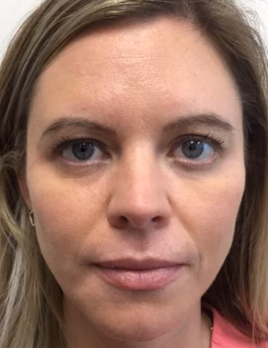 Botox before and after, Chrissy Handly, case 18609 - Cool Springs Plastic Surgery