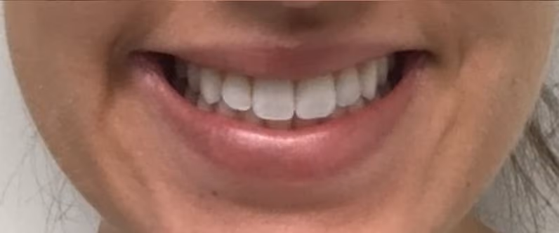 Botox before and after, Chrissy Handly, case 18629 - Cool Springs Plastic Surgery