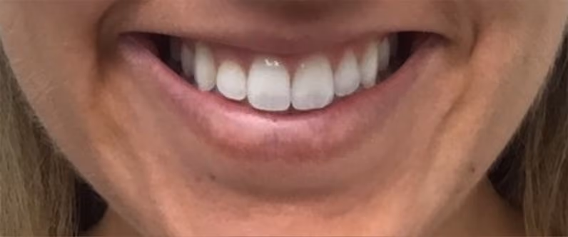 Botox before and after, Chrissy Handly, case 18629 - Cool Springs Plastic Surgery