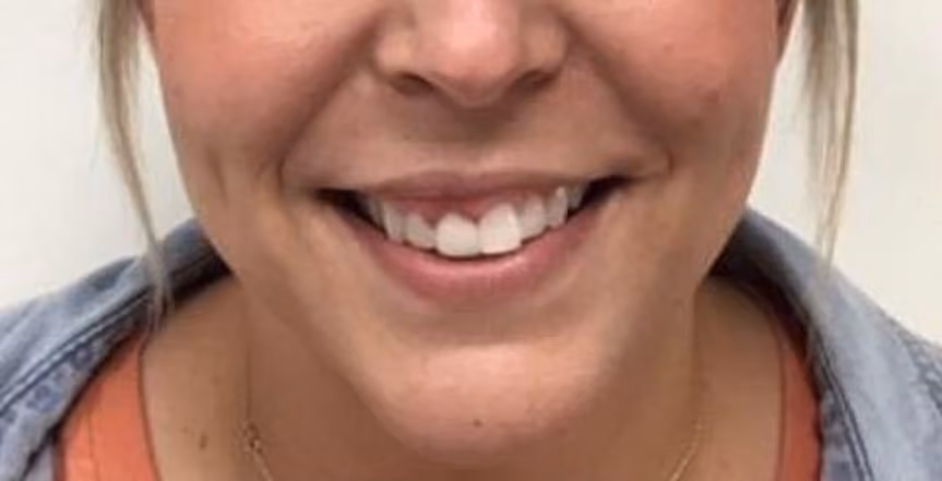 Botox before and after, Susan Vickers, case 18683 - Cool Springs Plastic Surgery