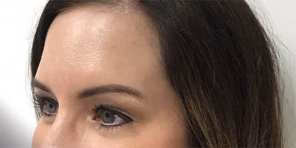 Botox before and after, Susan Vickers, case 20008 - Cool Springs Plastic Surgery