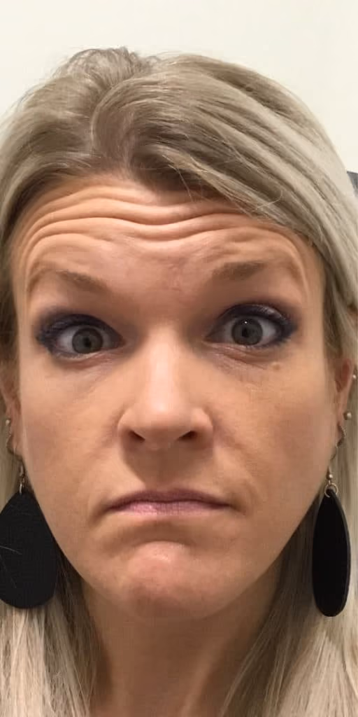 Botox before and after, case 20021 - Cool Springs Plastic Surgery