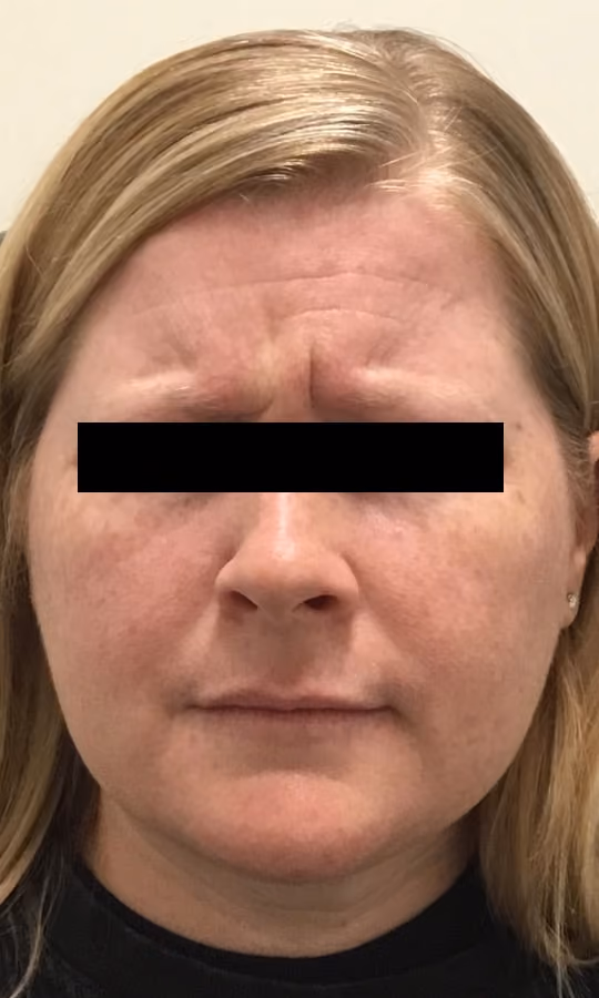 Botox before and after, case 20052 - Cool Springs Plastic Surgery