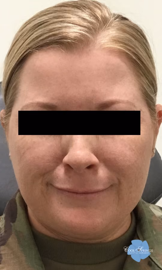 Botox before and after, case 20052 - Cool Springs Plastic Surgery