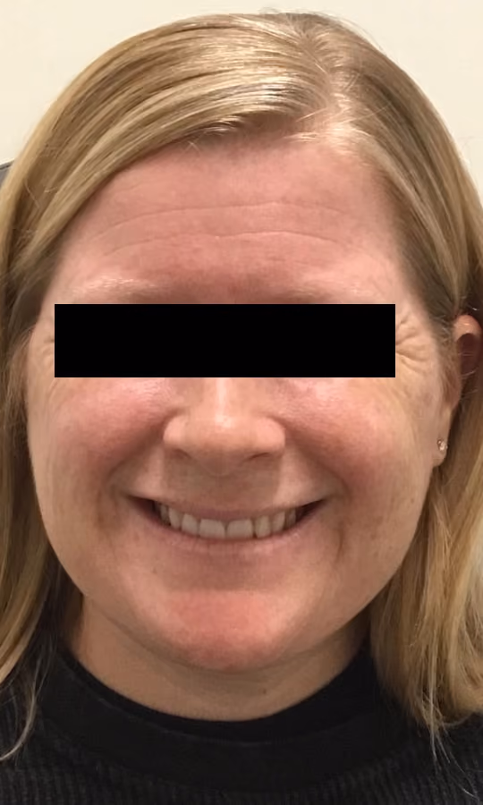 Botox before and after, case 20052 - Cool Springs Plastic Surgery