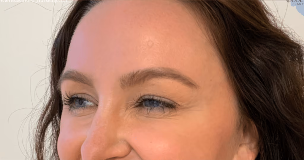 Botox before and after, Teresa Safford, case 20722 - Cool Springs Plastic Surgery
