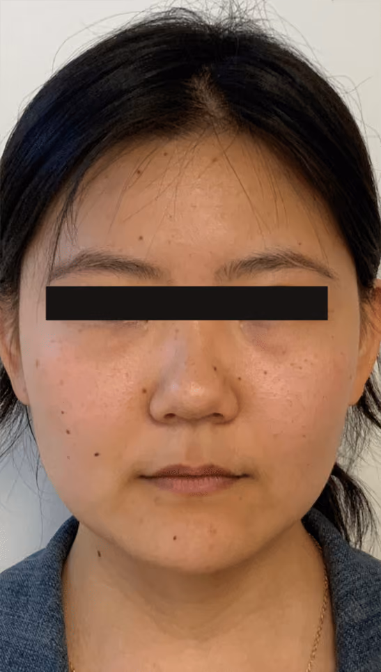 Botox before and after, Teresa Safford, case 20729 - Cool Springs Plastic Surgery