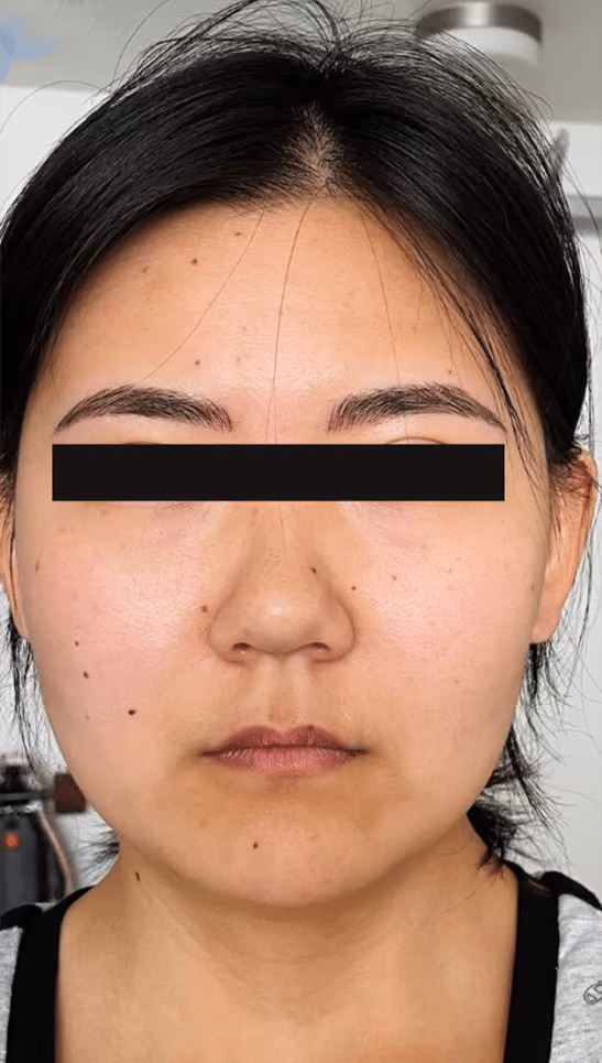 Botox before and after, Teresa Safford, case 20729 - Cool Springs Plastic Surgery