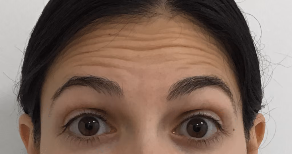 Botox before and after, Teresa Safford, case 20735 - Cool Springs Plastic Surgery