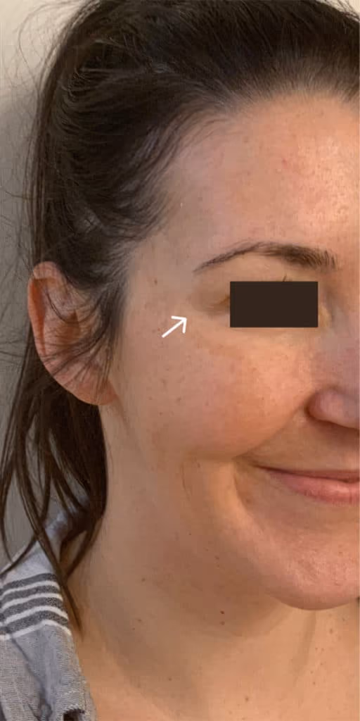 Botox before and after, case 22703 - Cool Springs Plastic Surgery