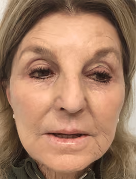 Botox before and after, Chrissy Handly, case 22864 - Cool Springs Plastic Surgery