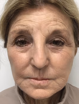 Botox before and after, Chrissy Handly, case 22864 - Cool Springs Plastic Surgery