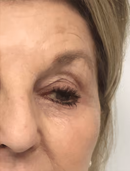 Botox before and after, Chrissy Handly, case 22864 - Cool Springs Plastic Surgery