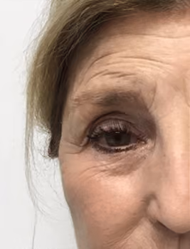 Botox before and after, Chrissy Handly, case 22864 - Cool Springs Plastic Surgery
