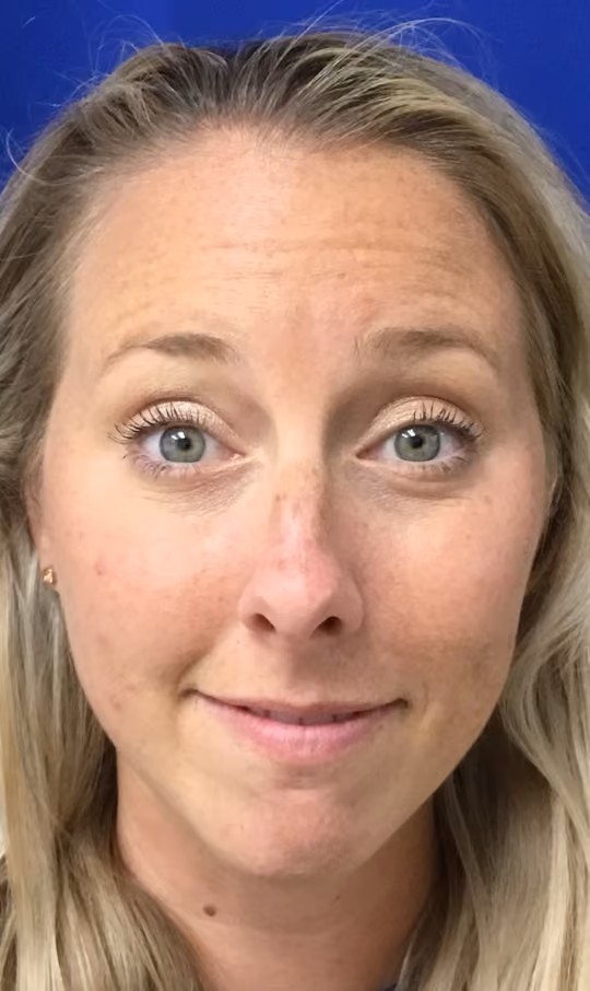 Botox before and after, Teresa Safford, case 26244 - Cool Springs Plastic Surgery