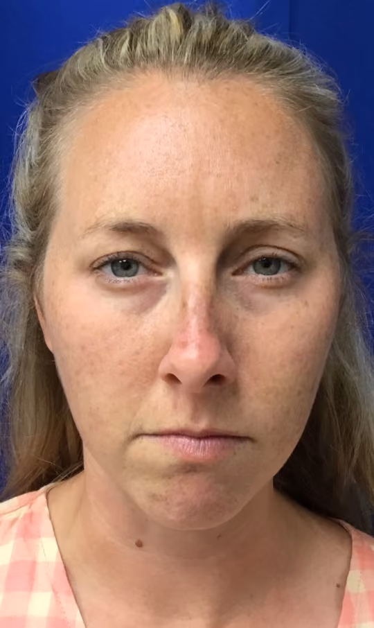 Botox before and after, Teresa Safford, case 26244 - Cool Springs Plastic Surgery