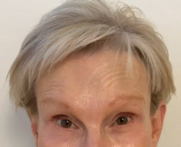Botox before and after, Teresa Safford, case 26253 - Cool Springs Plastic Surgery