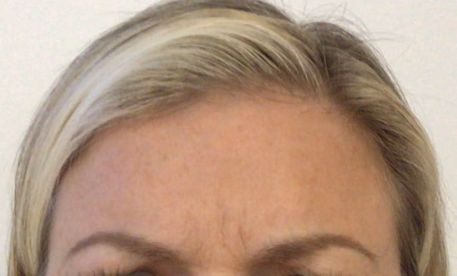 Botox before and after, Teresa Safford, case 26306 - Cool Springs Plastic Surgery
