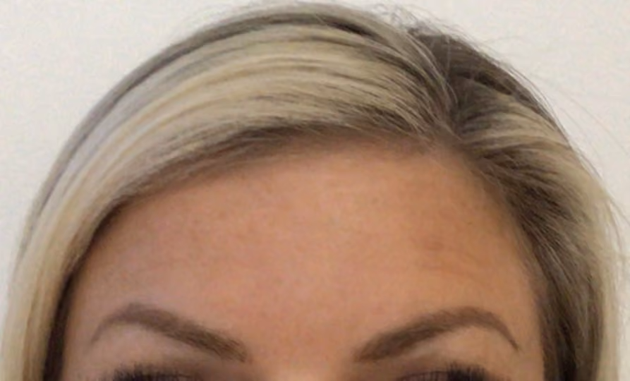 Botox before and after, Teresa Safford, case 26306 - Cool Springs Plastic Surgery