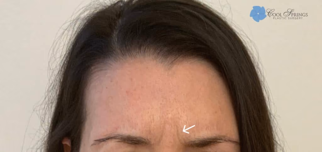 Botox before and after, Teresa Safford, case 26352 - Cool Springs Plastic Surgery