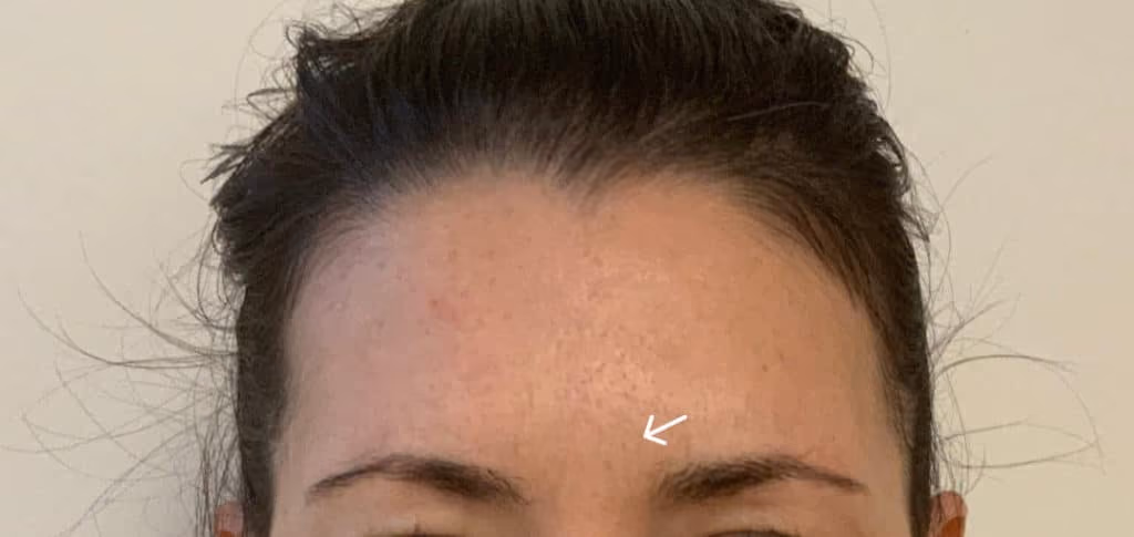 Botox before and after, Teresa Safford, case 26352 - Cool Springs Plastic Surgery