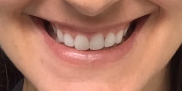 Botox before and after, Chrissy Handly, case 26536 - Cool Springs Plastic Surgery