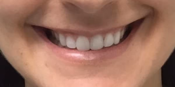 Botox before and after, Chrissy Handly, case 26536 - Cool Springs Plastic Surgery