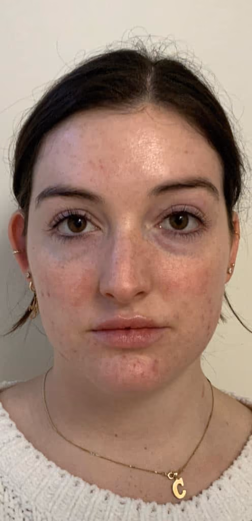 Botox before and after, Teresa Safford, case 26623 - Cool Springs Plastic Surgery
