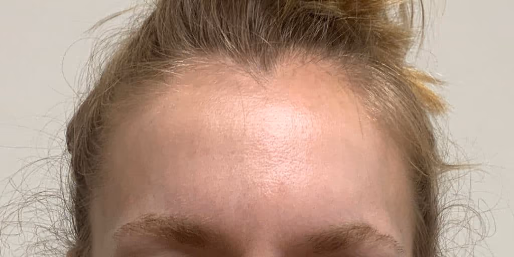 Botox before and after, Teresa Safford, case 26637 - Cool Springs Plastic Surgery