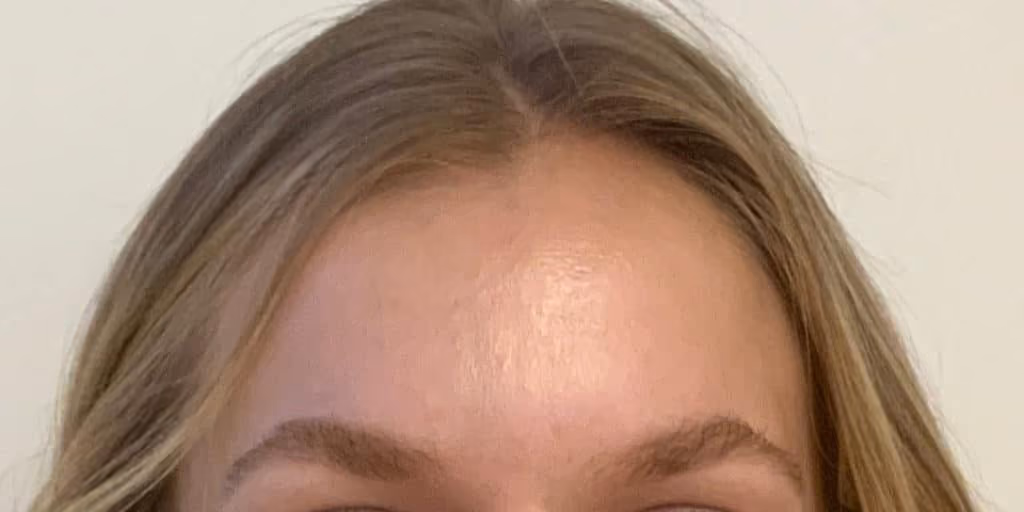 Botox before and after, Teresa Safford, case 26637 - Cool Springs Plastic Surgery
