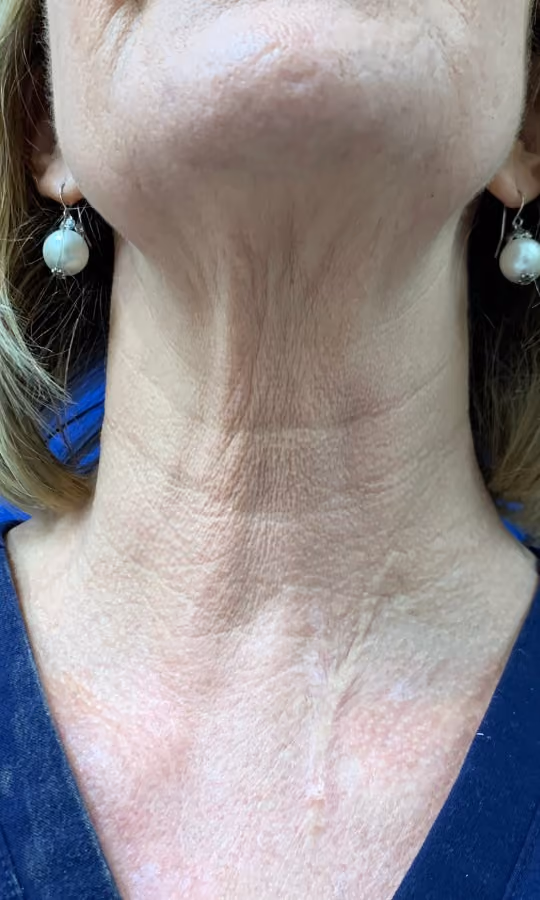 Botox before and after, Teresa Safford, case 26648 - Cool Springs Plastic Surgery