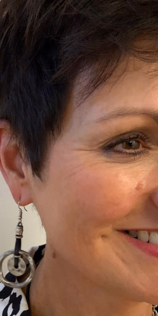 Botox before and after, Teresa Safford, case 26654 - Cool Springs Plastic Surgery