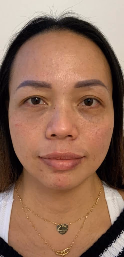 Botox before and after, Teresa Safford, case 26665 - Cool Springs Plastic Surgery