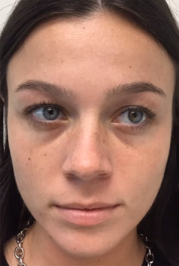 Botox before and after, Chrissy Handly, case 27085 - Cool Springs Plastic Surgery